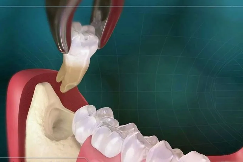 Кровит десна после удаления зуба