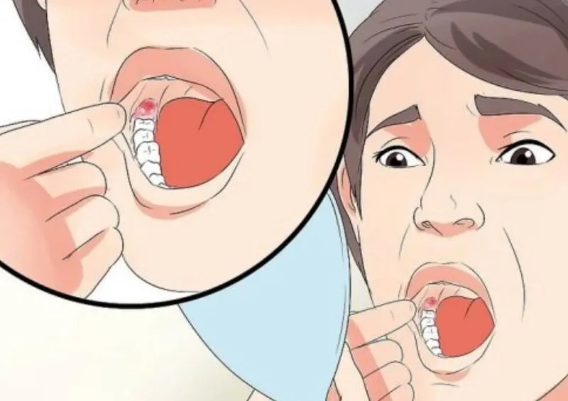 Болячка на десне около зуба