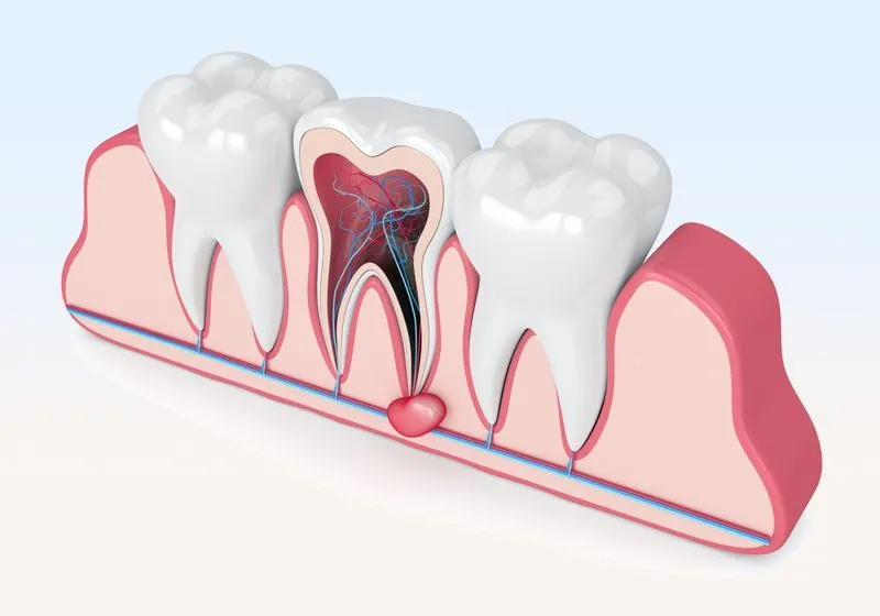 Что такое зубная киста