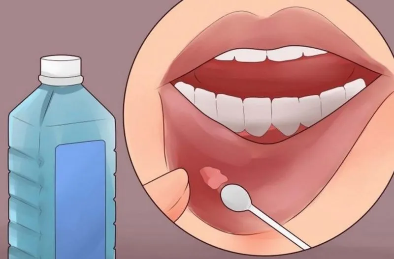 Воспаление полости рта как лечить