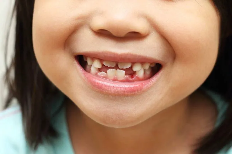 Какие зубы выпадают у детей