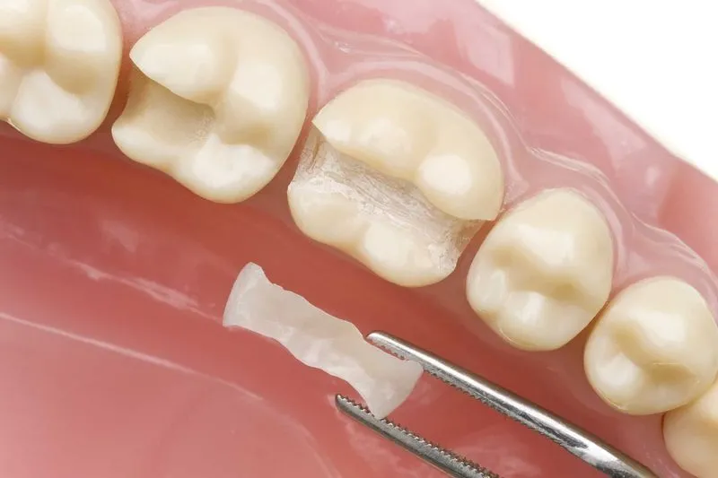 Реставрация сломанного зуба