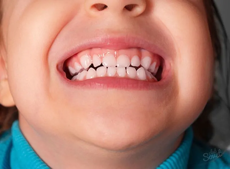 Посеребрение зубов у детей
