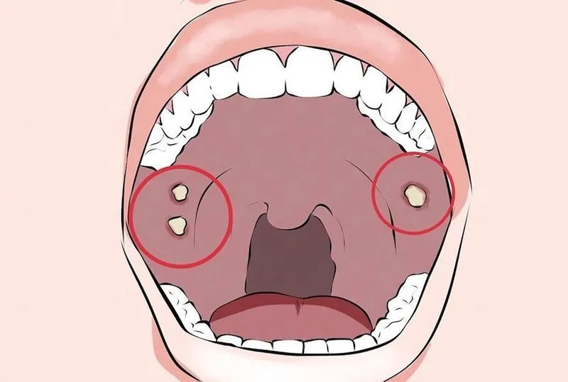 Как вылечить язвы во рту быстро