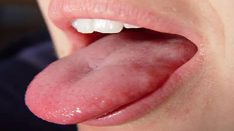 Воспаление полости рта