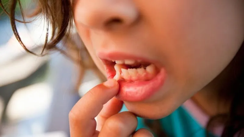 Как вытащить зуб без боли