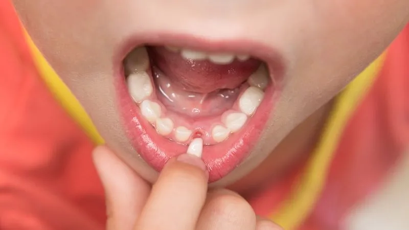 Воспаление в десне под зубом