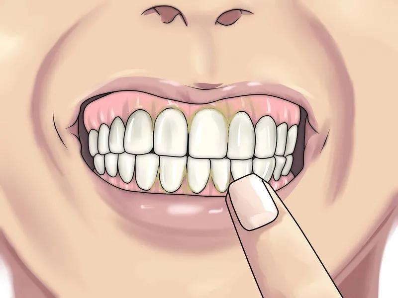 Зубной свищ лечение
