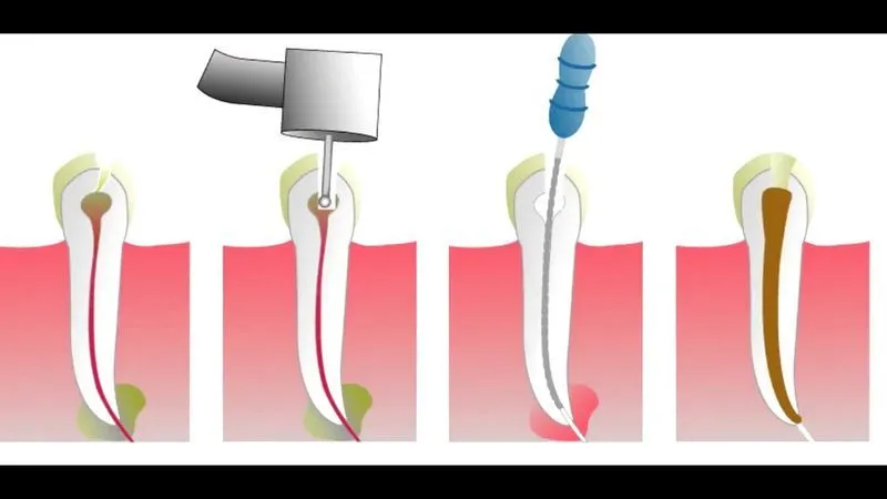Как ставят мышьяк в зуб