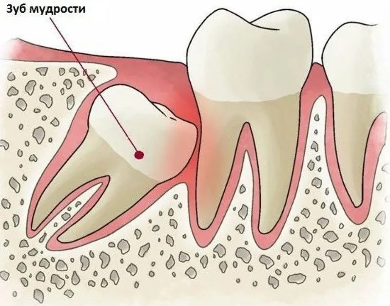 Болит место удаленного зуба