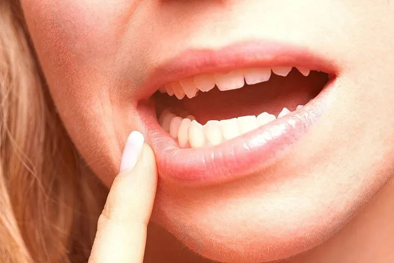 Болячка на внутренней стороне губы