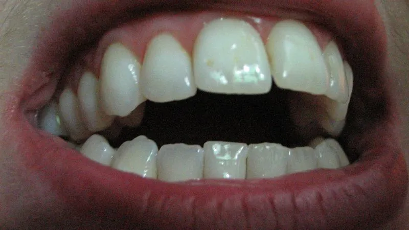 Хлоргексидин окрашивает зубы