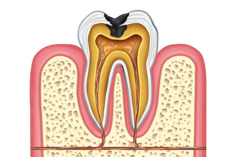 Болит ли зуб с мышьяком