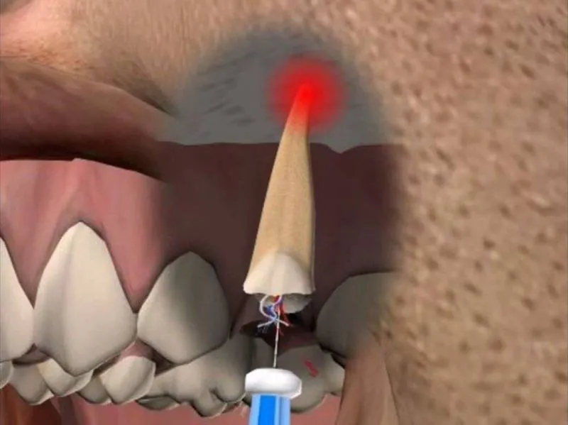 Киста десны зуба лечение