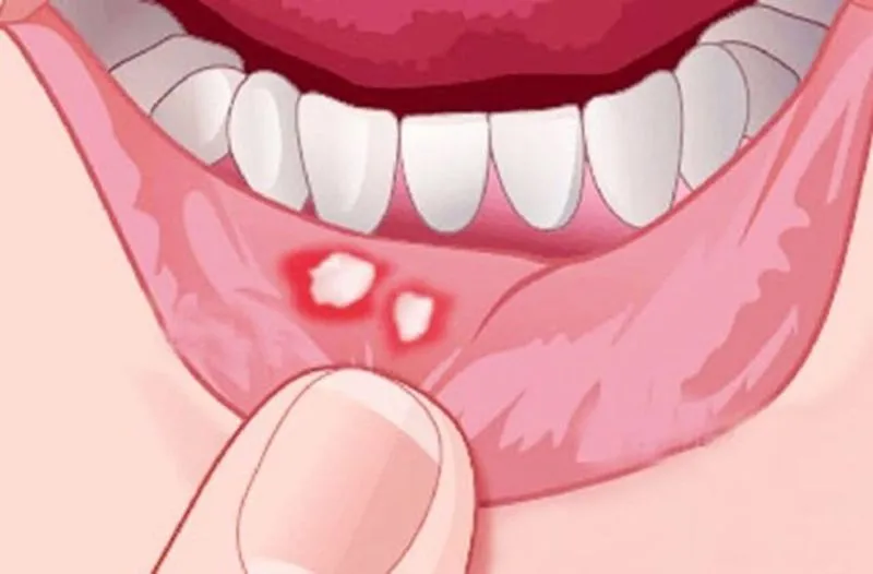 Лечение стоматита во рту