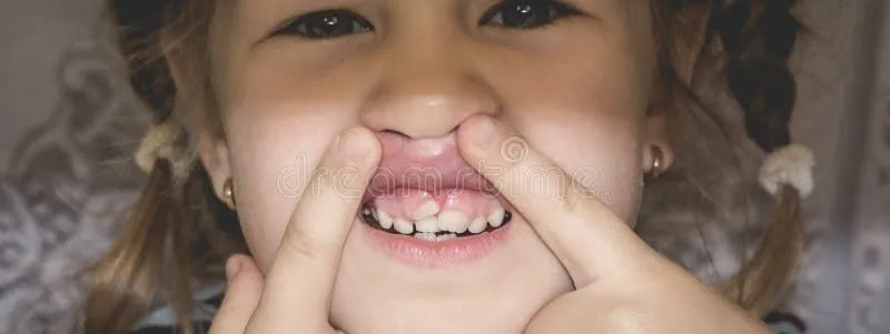 Лезут коренные зубы у ребенка