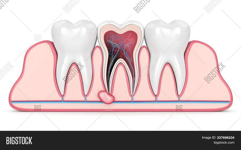 Что такое киста на зубе