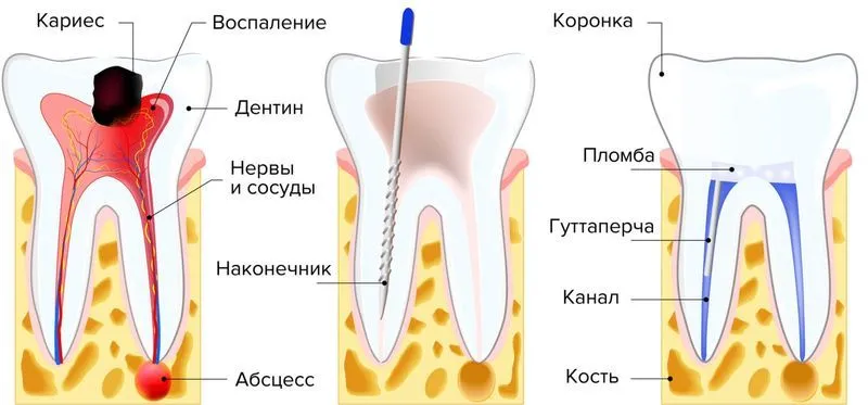 Как удаляют нерв зуба