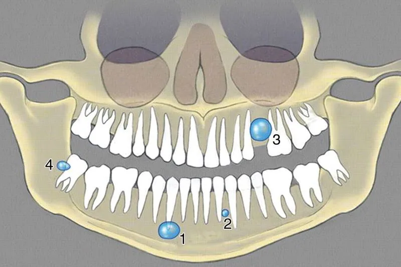 Киста в десне зуба лечение