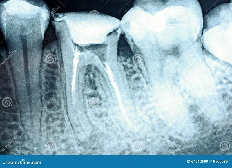 Воспаление корня зуба