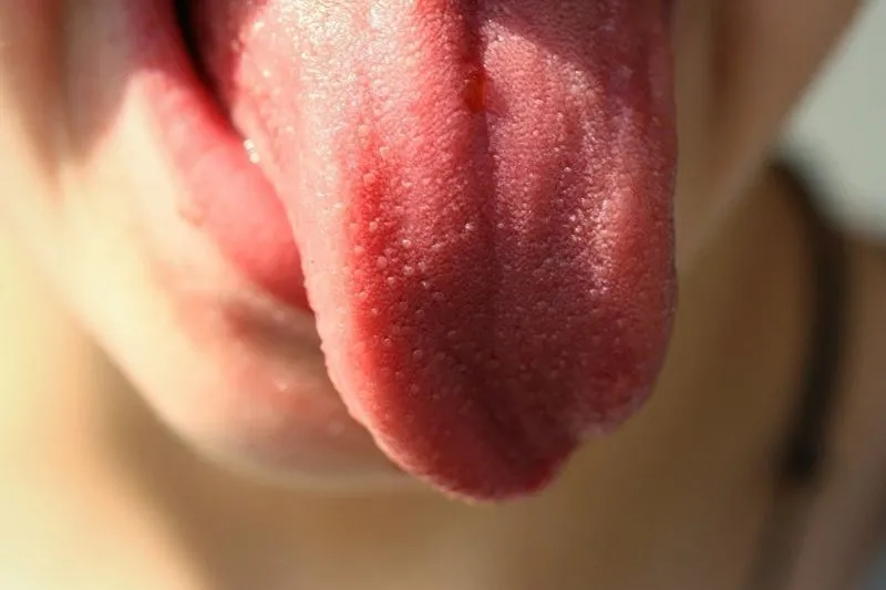 У ребенка язык в белом налете