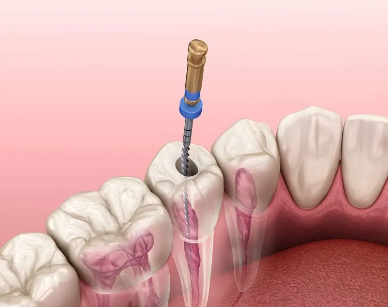 Больно ли лечить зуб без нерва