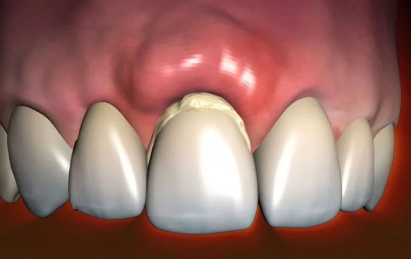 Оголение шейки зуба лечение