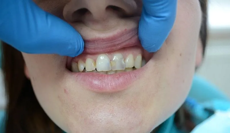 Почему у детей чернеют зубы