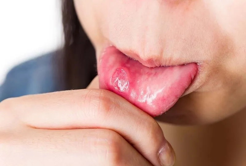 Во рту на губе белое пятно болит