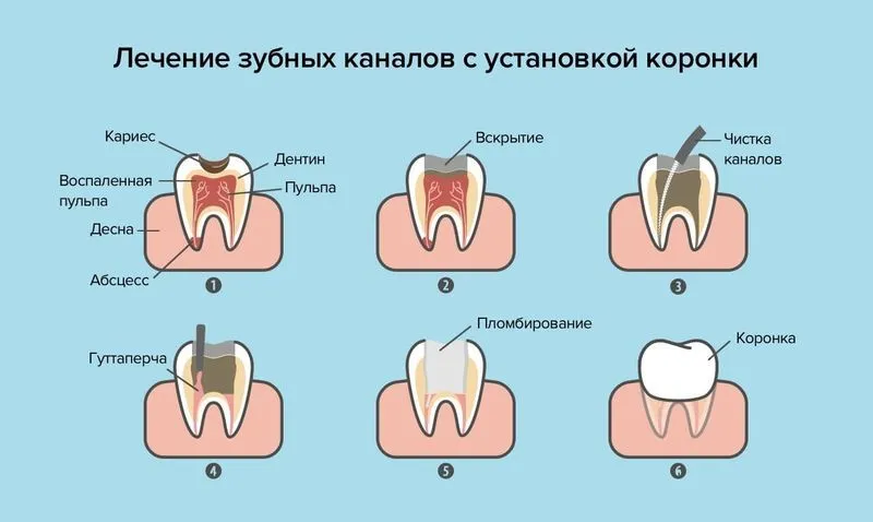 Болит запломбированный зуб