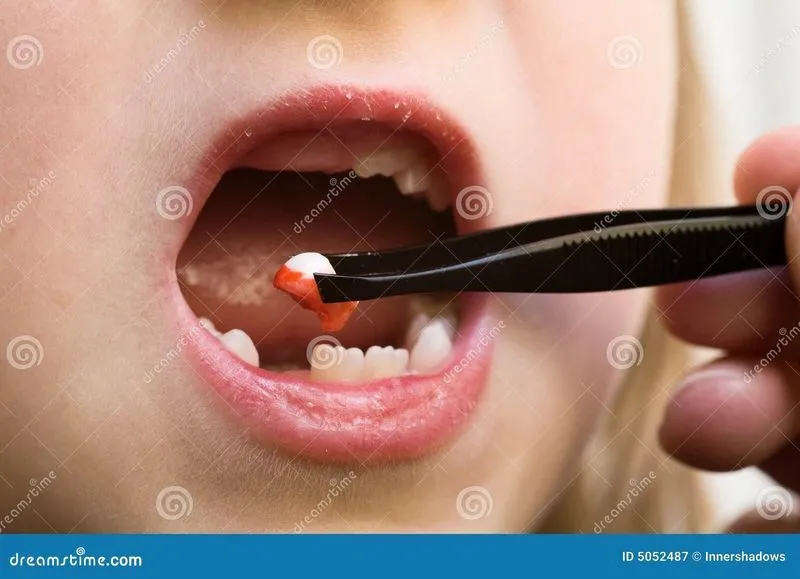 Течет кровь после удаления зуба