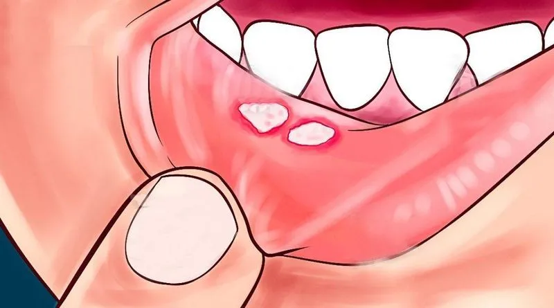 Стоматит на языке у ребенка чем лечить