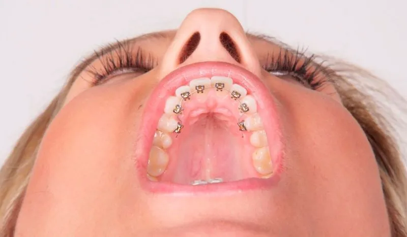 Зубы в брекетах болят