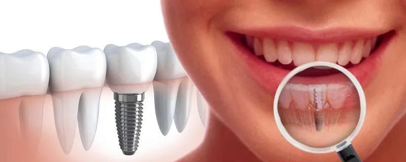 Имплантация зубов: простой способ восстановить улыбку комфорт жизни
